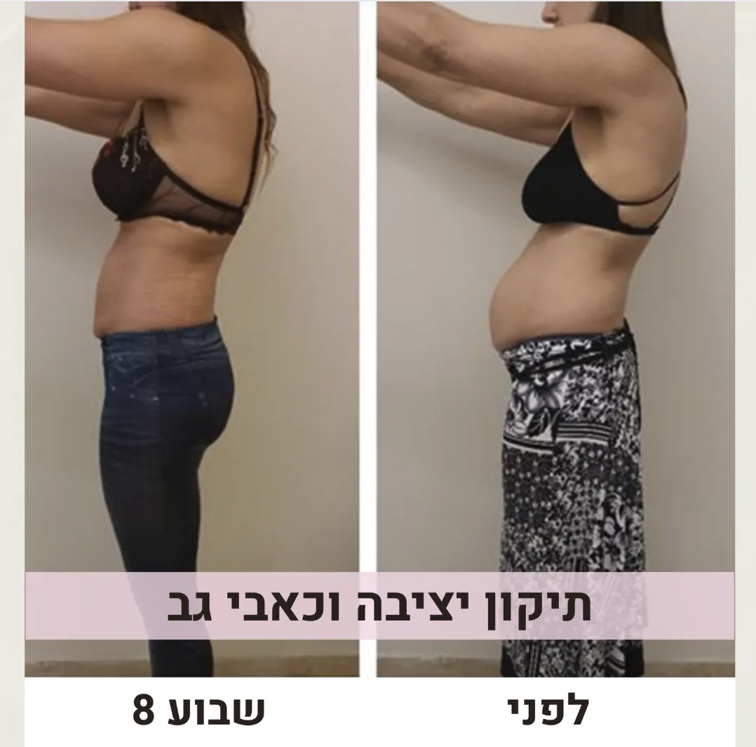 צילום צד של אישה לפני ואחרי 8 שבועות תרגול בשיטת העוטפת: שינוי בקו הבטן וביציבה